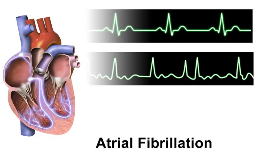 A recent review article examines evidence on sepsis-associated atrial...
