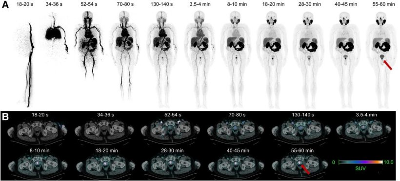 Prostate cancer: PSMA PET/CT-targeted biopsy improves detection