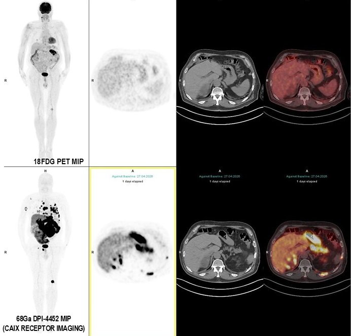 ccRCC kidney cancer: PET/CT imaging approach improves lesion detection