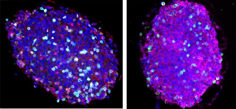 Wie Glioblastome das Immunsystem lahmlegen