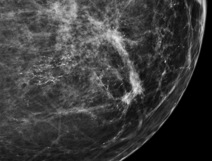 Mammogram microcalcifications in ductal carcinoma in situ, CC