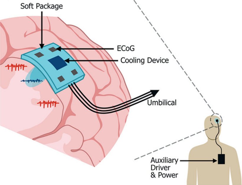 Concept of an implantable system for focal brain cooling