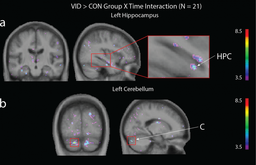 A significant effect was observed in the (a) left hippocampus and (b) left...