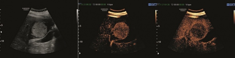 Liver lesion of a neuroendocrine tumour in the B-image and with CEUS in...