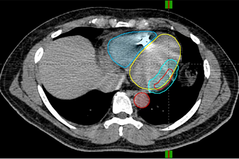 A novel strategy to treat a life-threatening irregular heart rhythm called...