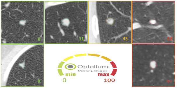 Pulmonary nodule malignancy scores predicted by a research prototype of the...