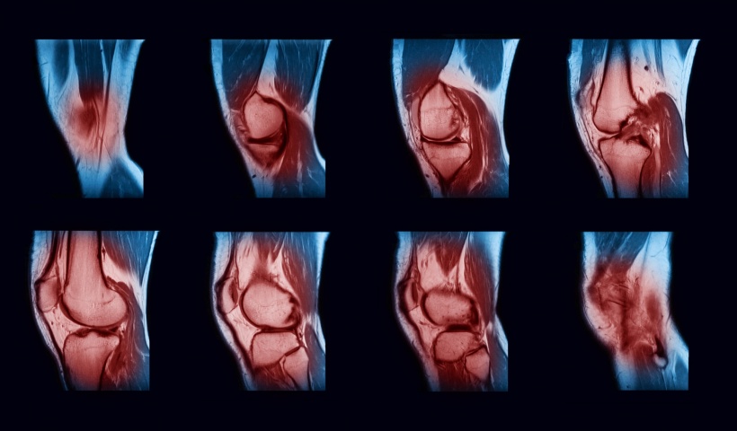 Magnetic resonance imaging (MRI) of right knee, Knee joint effusion and...