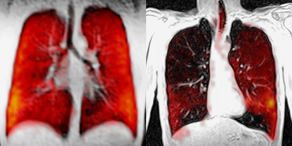 Normal case with Xenon.