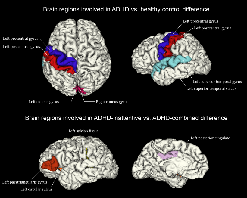 Normal Brain And ADHD Brain