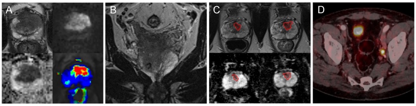 Prostate gland cancer mri - Ízületi fájdalom a bal hüvelykujjnál