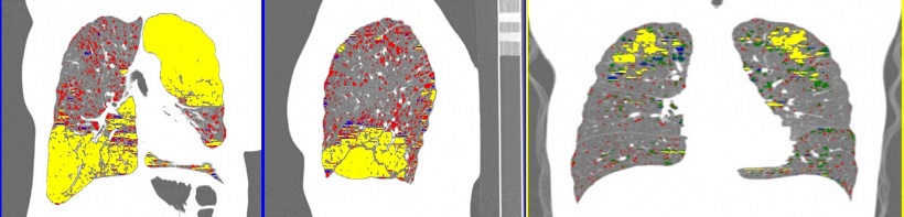 Links und Mitte: Inhomogene Verteilung des Emphysems (gelb markiert), die sich...