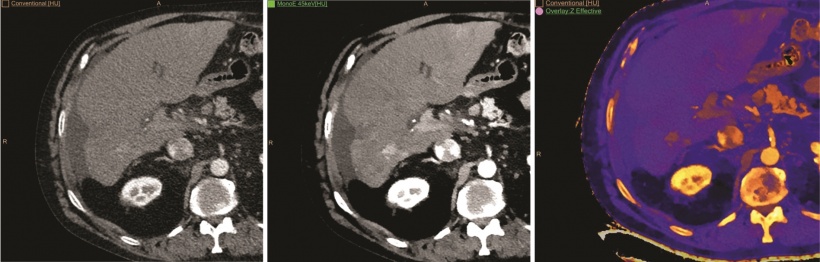 Die konventionelle CT-Aufnahme zeigt eine suspekte Läsion in der Leber (linkes...