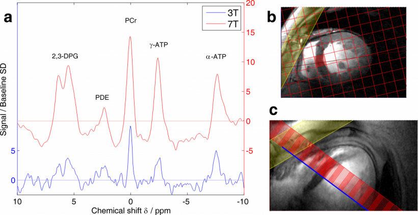 Figure A, Graph shows comparison of spectra in a typical patient (57-year-old...