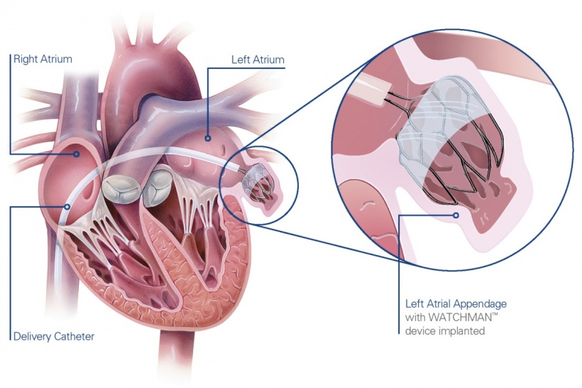 LAA with WATCHMAN device