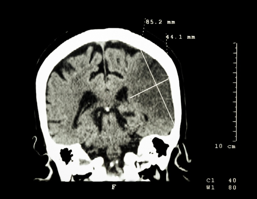 Cerebral infarction at left hemisphere (CT-scan).