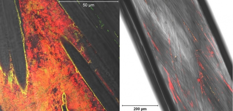 Comparison between Triclosan impregnated suture and two non-impregnated...