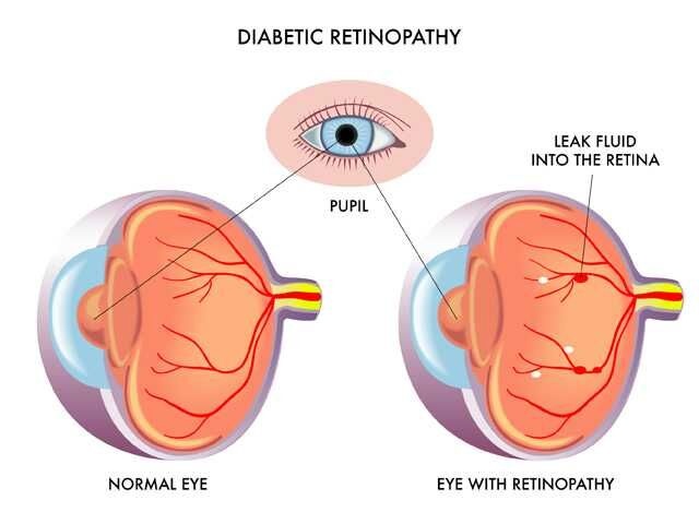 Annual dilated eye exams key in preventing diabetic eye disease