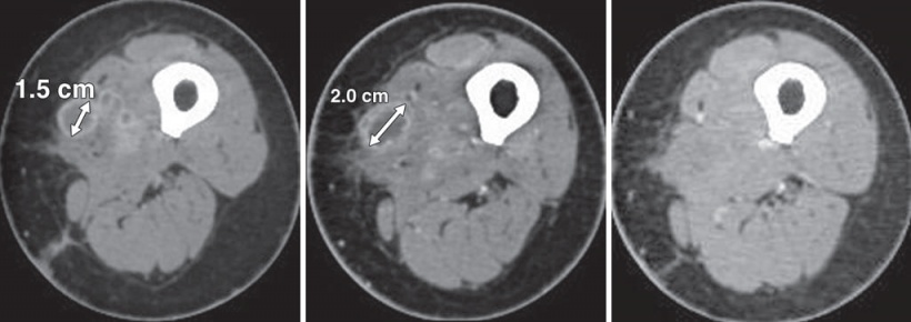 Melanoma reaction to Ipilimumab treatment. Although the CT images initially...