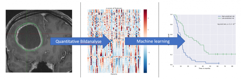 Radiomics: Radiology images (below, left) undergo feature extraction and...