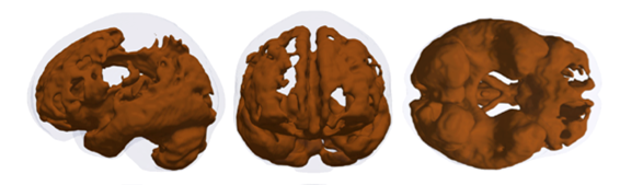 Brain regions showing age-related atrophy from the initial 5,000 individuals...