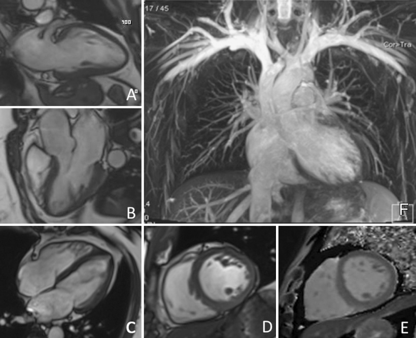 Examples of MR images acquired as part of the cardiovascular protocol:
A–C:...