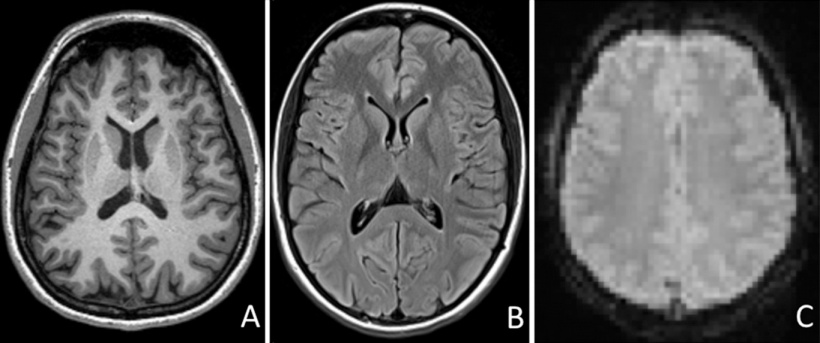 MR images obtained as part of the neurologic MR imaging protocol
A: T1-weighted...