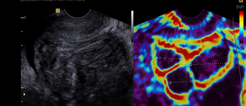 Myomen presenting during sonoelastography and a normal grey echo.