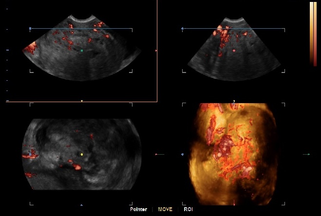 The growth of myomen is predictable on the basis of the vasculair index...