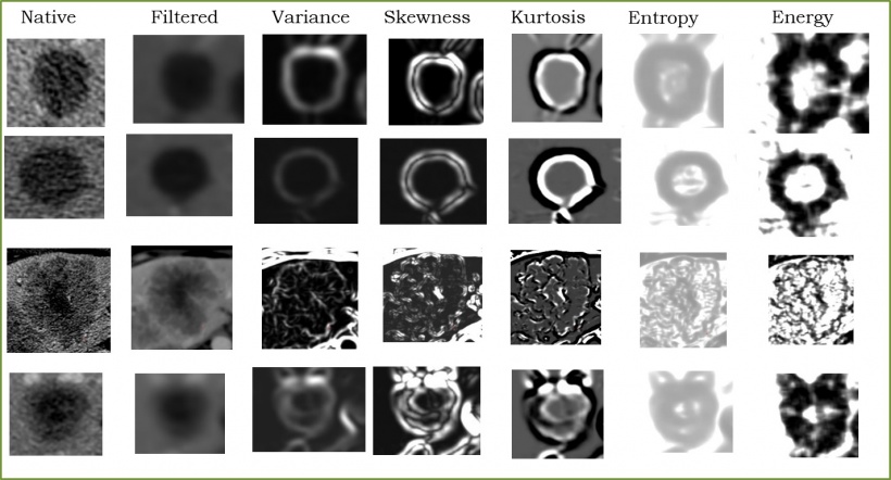 Texture analysis of liver metastases showing tumor heterogeneity. Processing of...