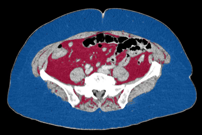 A cross-sectional CT scan of a female kidney cancer patient shows relatively...