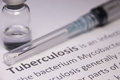 New blood test predicts TB onset up to two years in advance