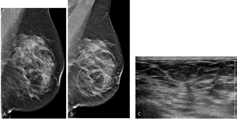 Additional Cancer Screening For Women With Dense Breasts Healthcare