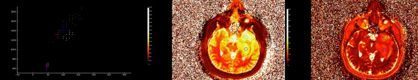 1.5T MR Fingerprinting T1 and T2 map of high grade glioma. MRF promises the...