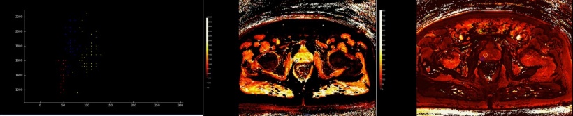 3-T MR Fingerprinting T1 and T2 map of a biopsy confirmed low grade prostate...