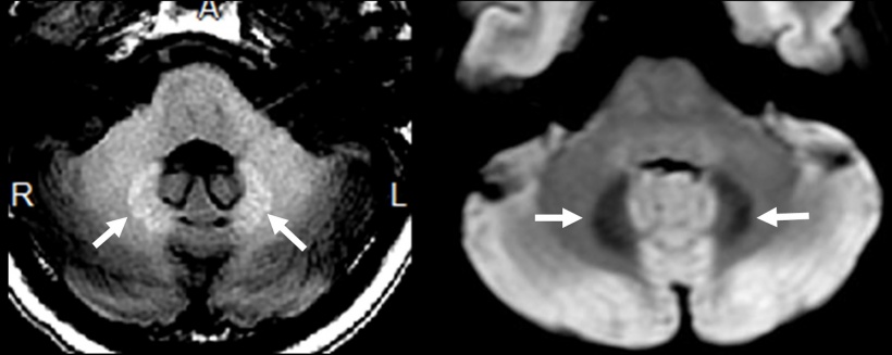 Asymptomatic metal deposition in the dentate nucleus, gadolinium deposition on...