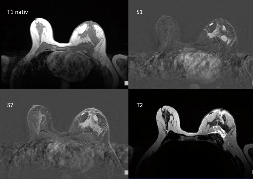 Mammogram Vs. Breast MRI: What's the Difference? - Intercoastal