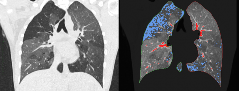 Linke Seite: reguläres CT bei Verdacht auf COPD. Rechte Seite:...