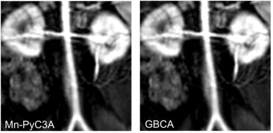 MRT-Kontrastmittel auf Manganbasis (linkes Bild) zeigen bei Abdominalbildern...