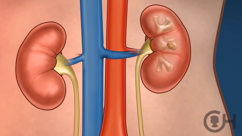 can antibiotics help kidney stones