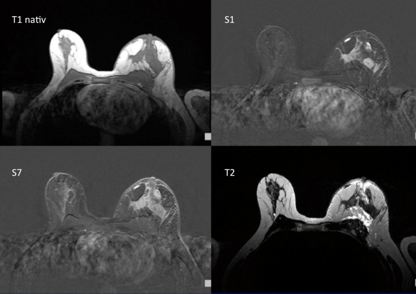 Dynamisch multiparametrische MR-Mammographie mit Mammakarzinom der linken Brust.
