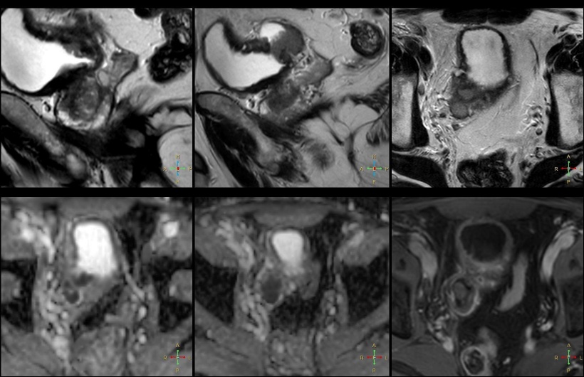 Tumor of a posterior wall of urinary bladder extending through muscular layer...