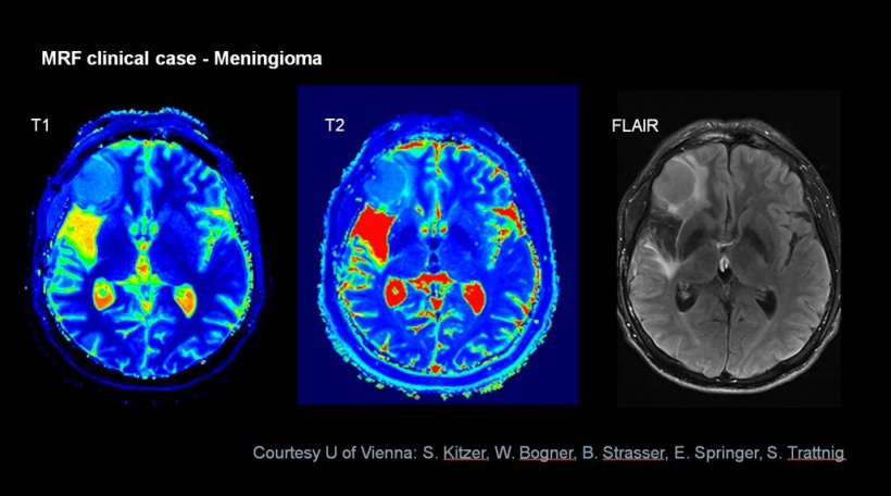 Brain tumour displayed with MR Fingerprinting