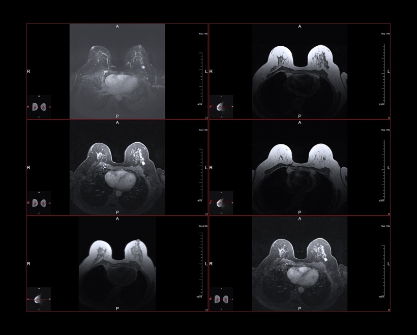 Breast magnetic resonance image, or MRI. The bright white dot in the larger...