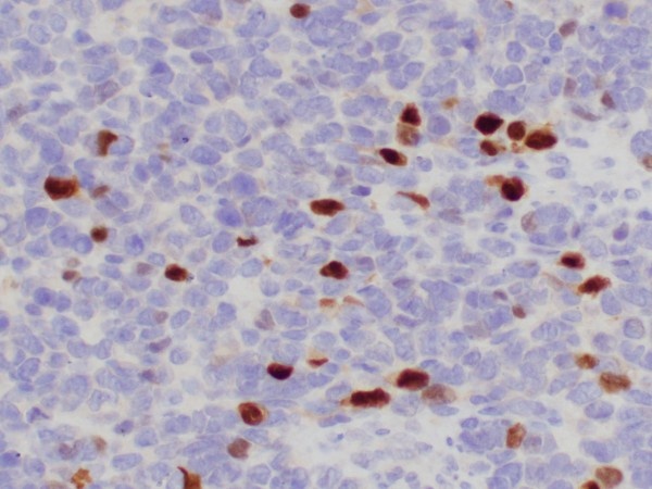 Embryonal rhabdomyosarcoma cells