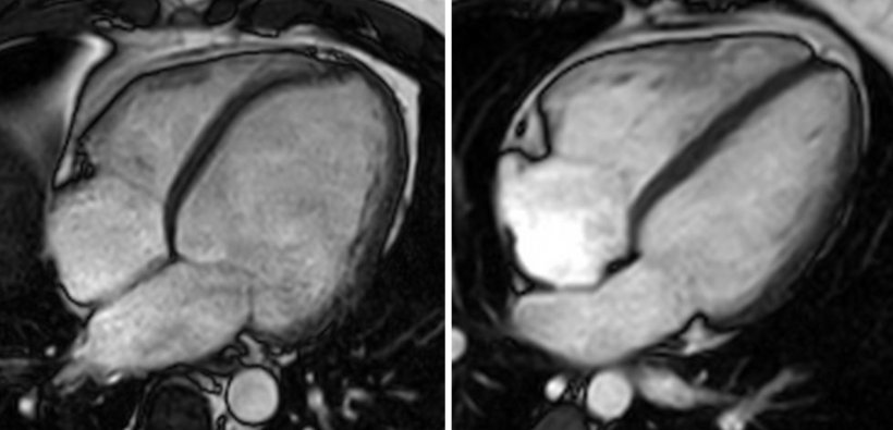 heart imaging of dcm affected patient opposed to normal heart