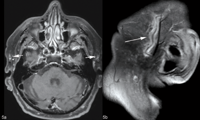 Kontrastmittel-verstärkte T1 fs 3D-mVISTA des Kopfes von einem Patienten mit...