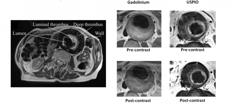 USPIO imaging in the Abdominal Aortic Aneurysm