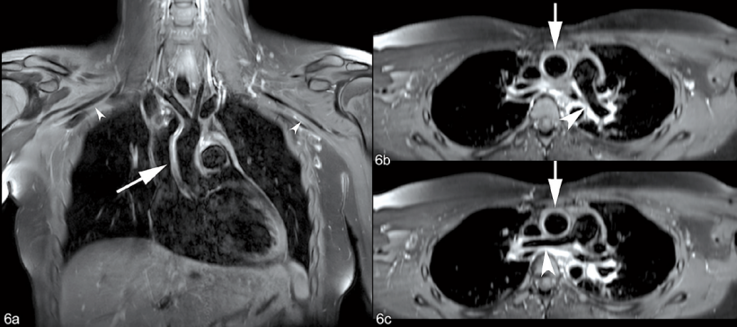 Kontrastmittelverstärkte, EKG-getriggerte und atemnavigierte T1 fs 3D-mVISTA...