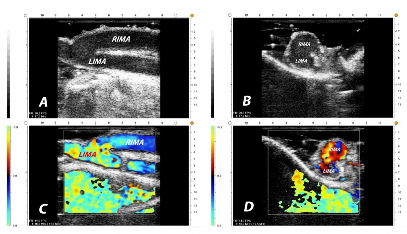 Y-conduit of right and left internal thoracic artery in epicardial ultrasound....