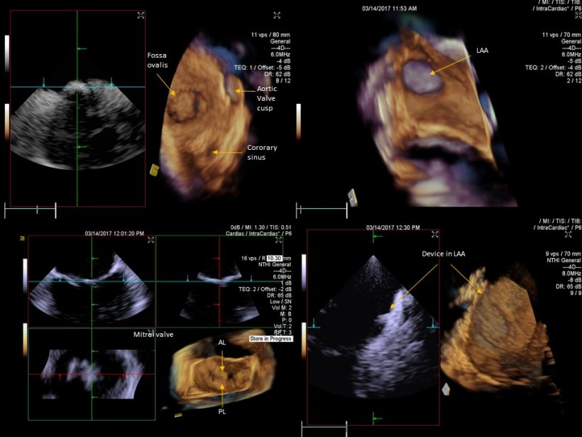 Intracardiac echocardiography (ICE) provides cardiologists with useful...